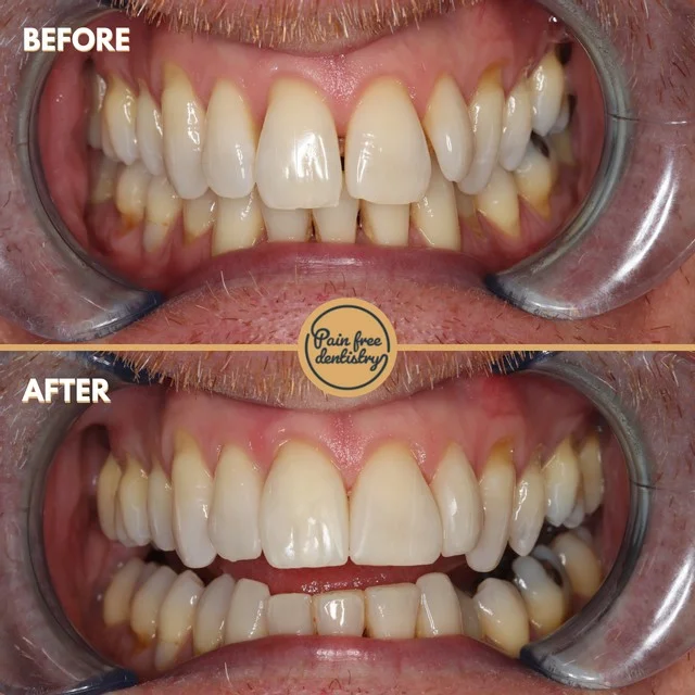 Composite bonding — the same patient's teeth before and after treatment