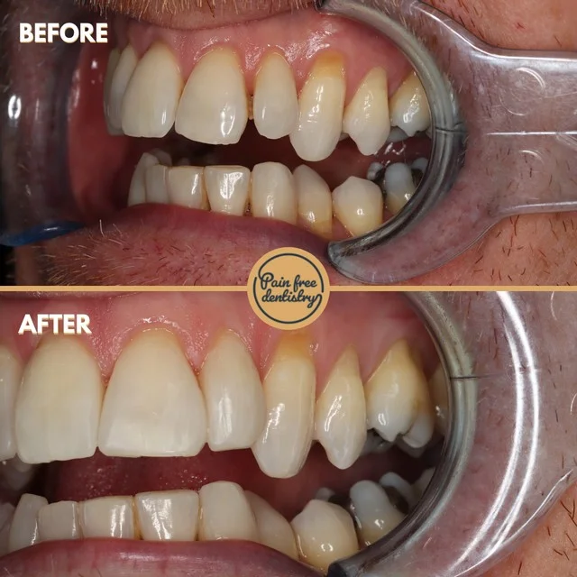 Composite bonding — the same patient's teeth before and after treatment