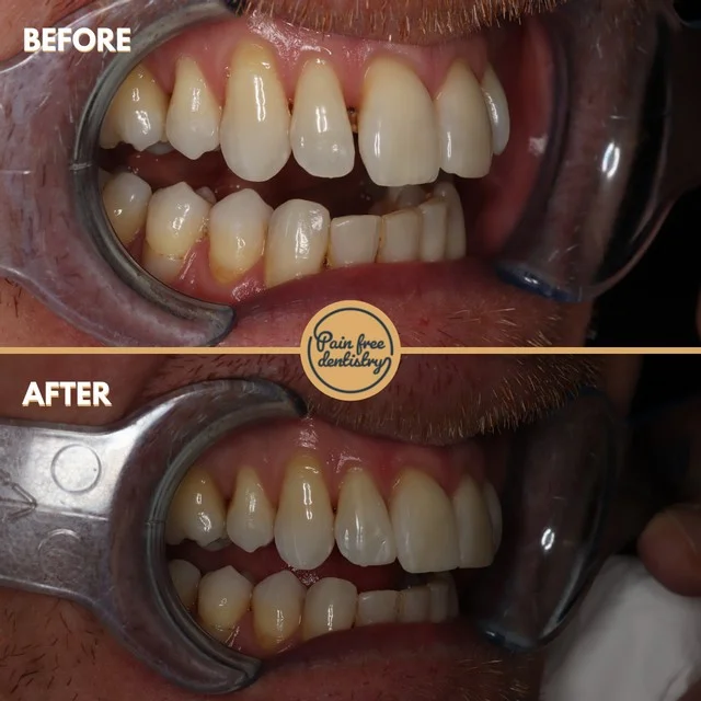 Composite bonding — the same patient's teeth before and after treatment