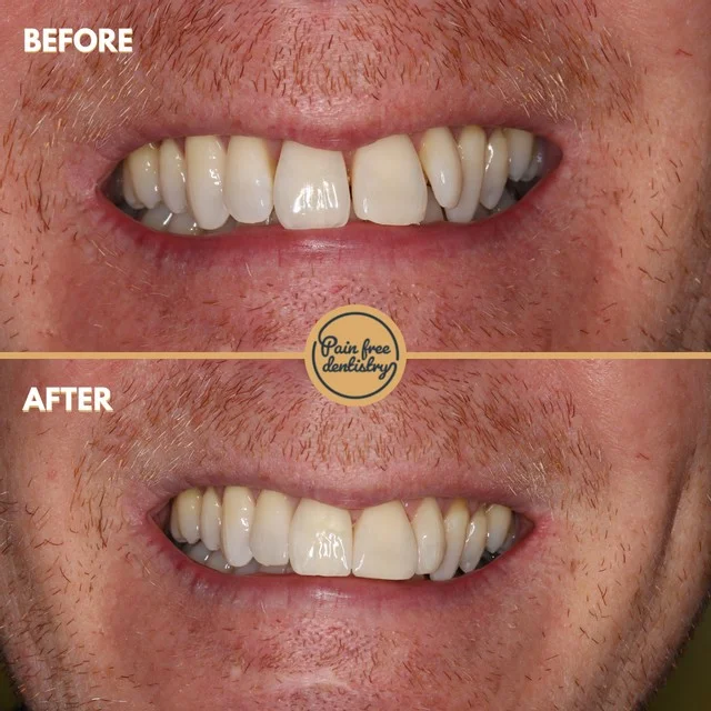Composite bonding — the same patient's teeth before and after treatment