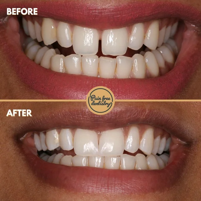 Gap closure with resin — the same patient's teeth before and after treatment