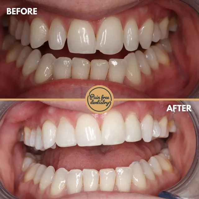 Teeth straightening — the same patient's teeth before and after treatment