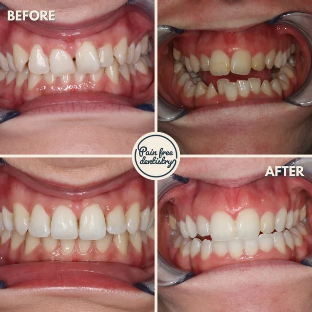 Teeth straightening — the same patient's teeth before and after treatment