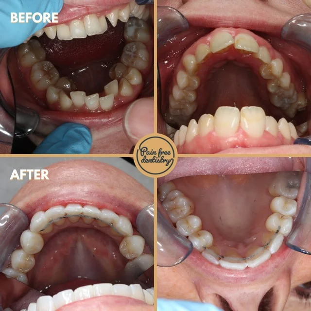 Straight Teeth