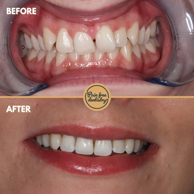 Teeth straightening — the same patient's teeth before and after treatment