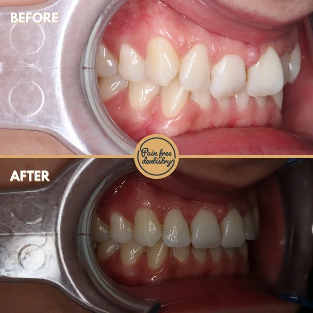Teeth straightening — the same patient's teeth before and after treatment