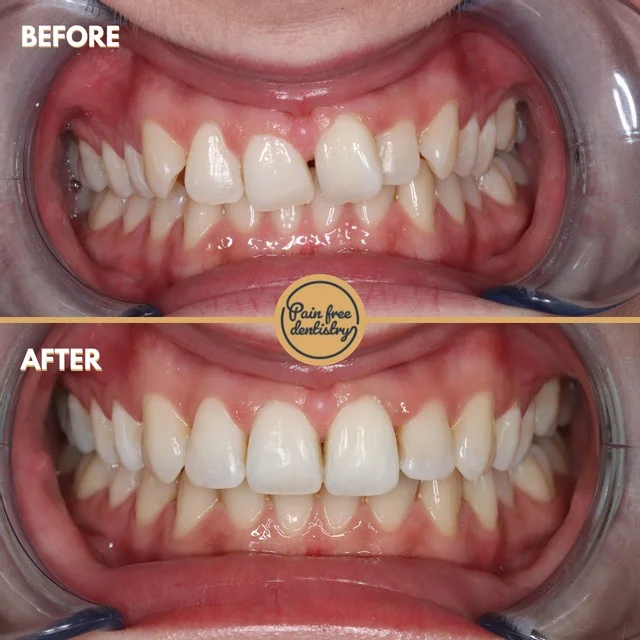 Teeth straightening — the same patient's teeth before and after treatment