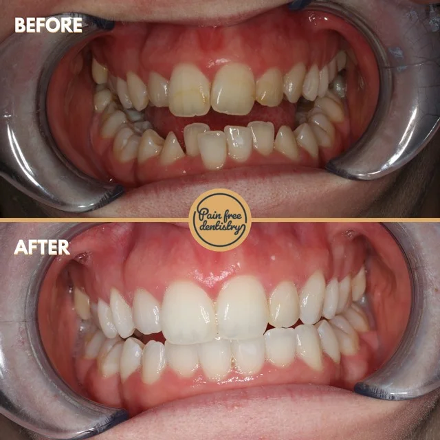 Teeth straightening — the same patient's teeth before and after treatment