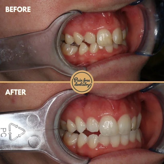 Straight Teeth