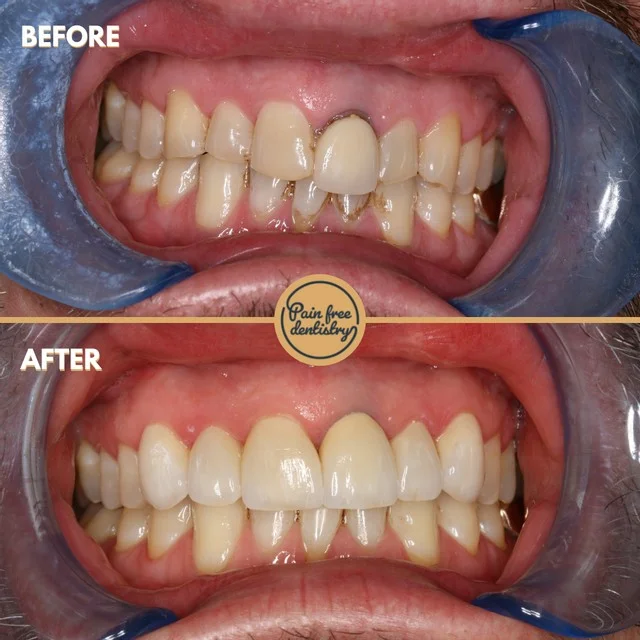 Veneers — the same patient's teeth before and after treatment