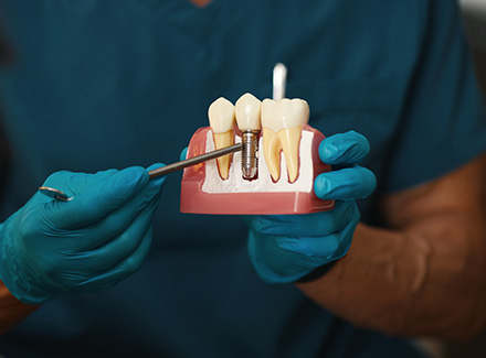 Dental Implants