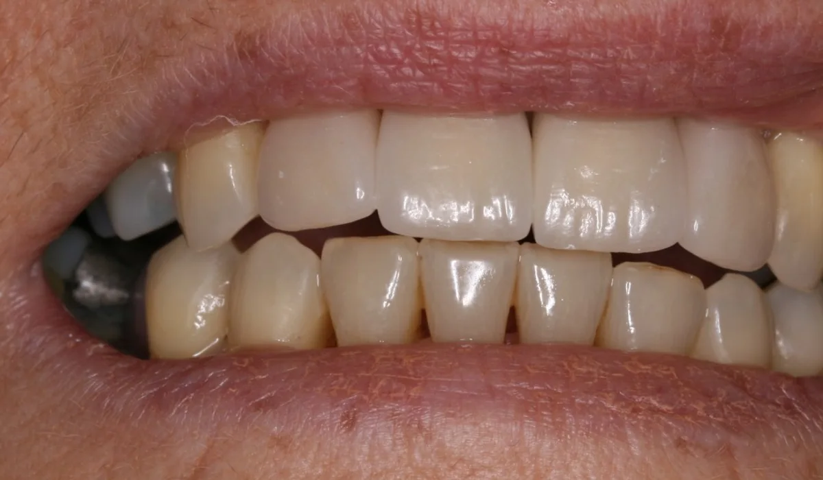After treatment: the same patient with a complete row of upper front teeth