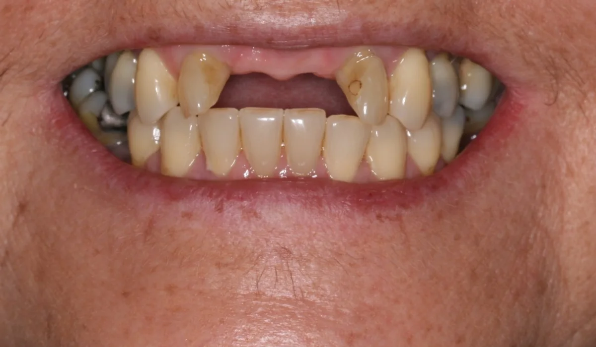 Before treatment: both upper front teeth missing, leaving a gap
