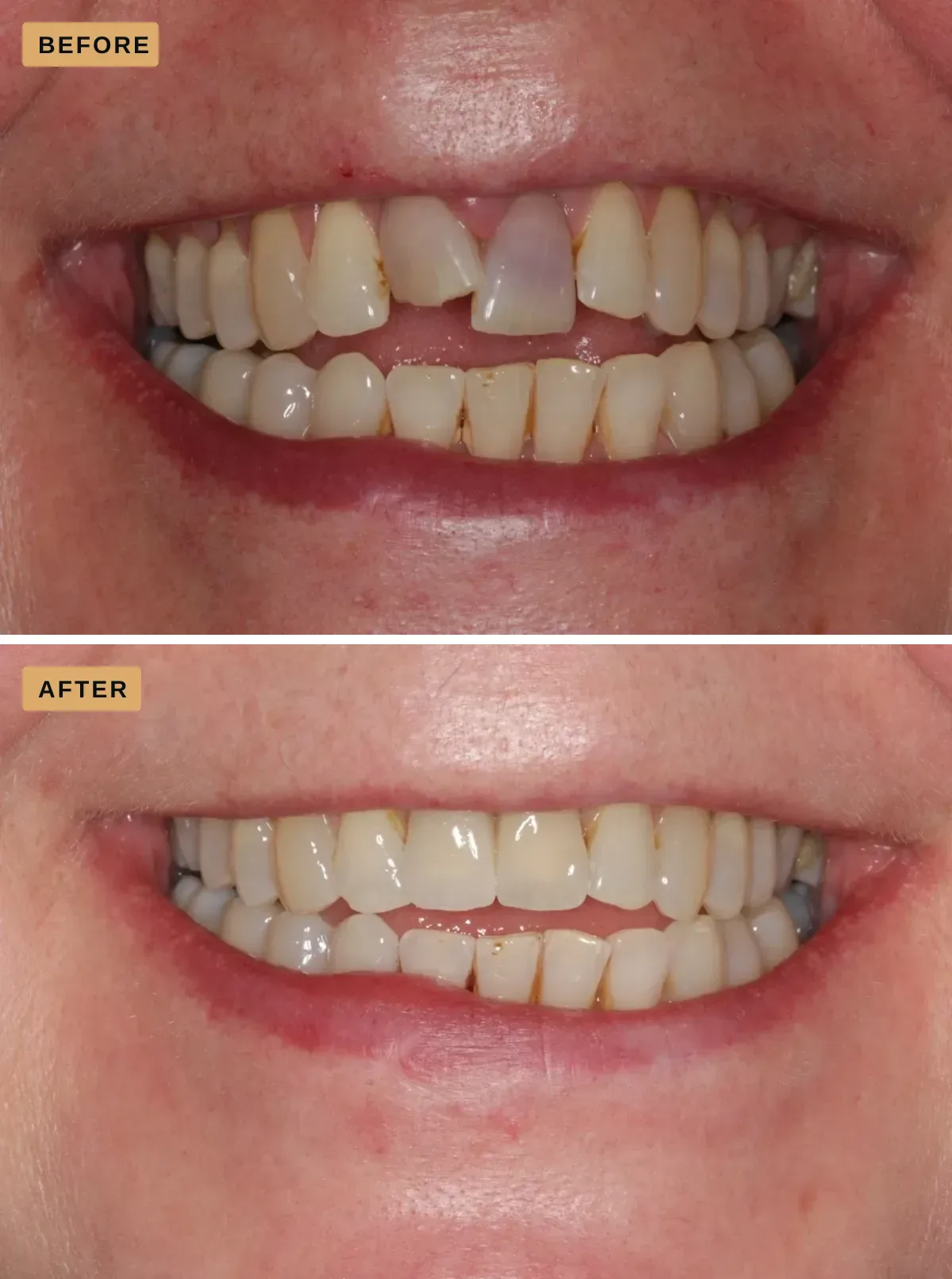 Dental implants — the same patient before treatment, with a broken and a darkened upper front tooth and a gap between them, and after, with a complete, even row of upper front teeth