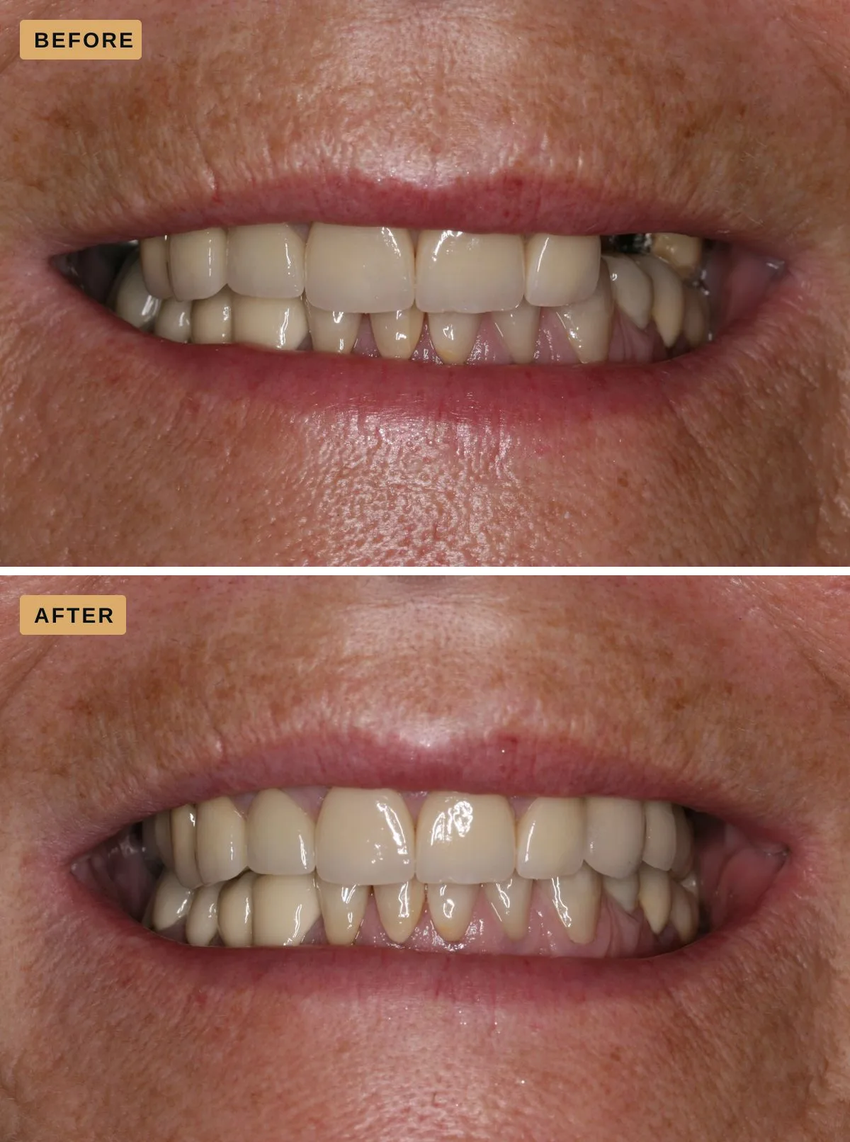 Dental implants — the same patient before treatment, with metal showing at the upper back teeth, and after, with the upper teeth restored