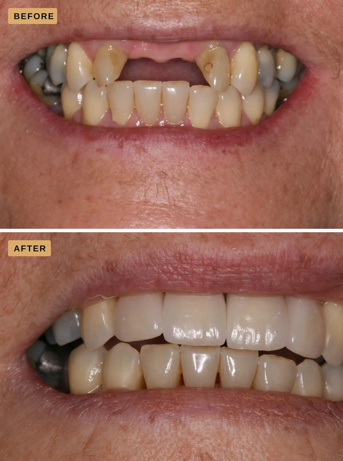 Dental implants — the same patient before treatment, with both upper front teeth missing, and after, with a full row of upper front teeth